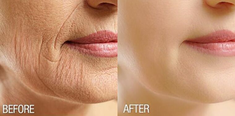Facial skin before and after the Yenki Derm course, the effect of the serum