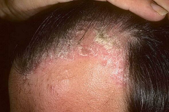 Psoriasis symptoms