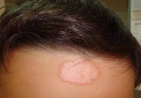 Psoriatic spot