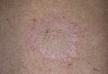The phenomenon of the stearine spot