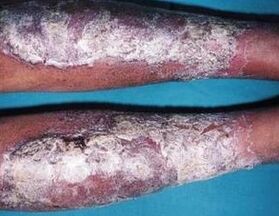 Ointment from psoriasis