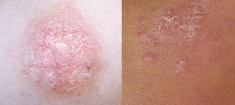 Psoriasis at the initial stage