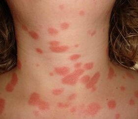 The phenomenon of the stearine spot